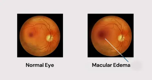 Ayurvedic Treatment for Macular Edema