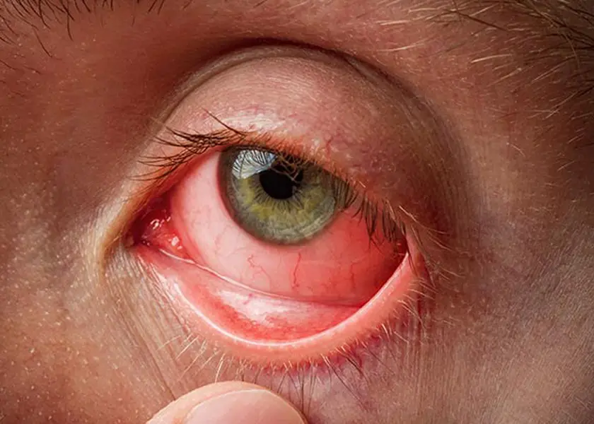 Conjunctivitis