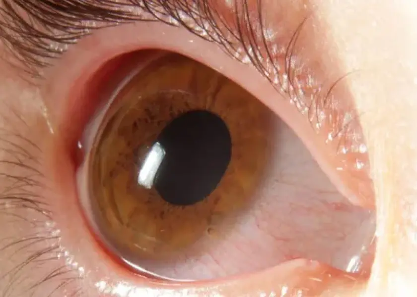 Corneal Dystrophy