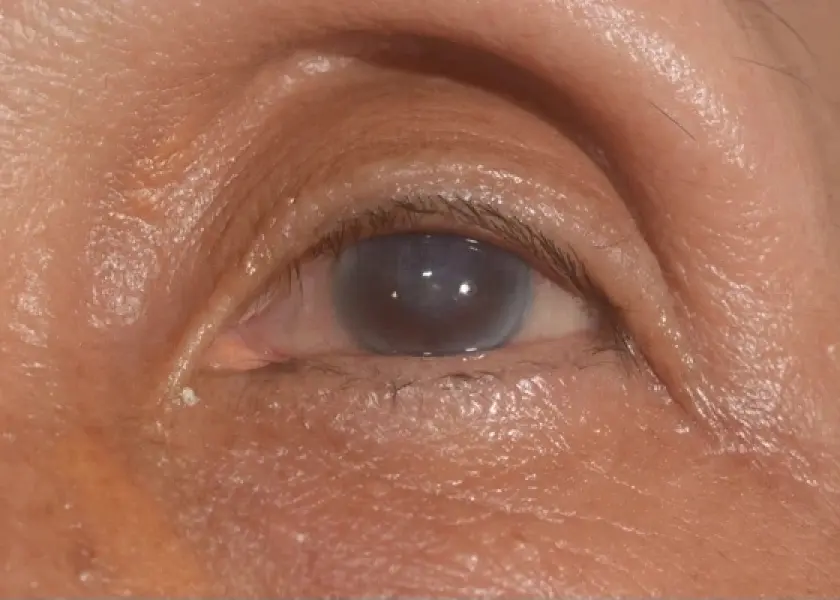 Corneal Edema