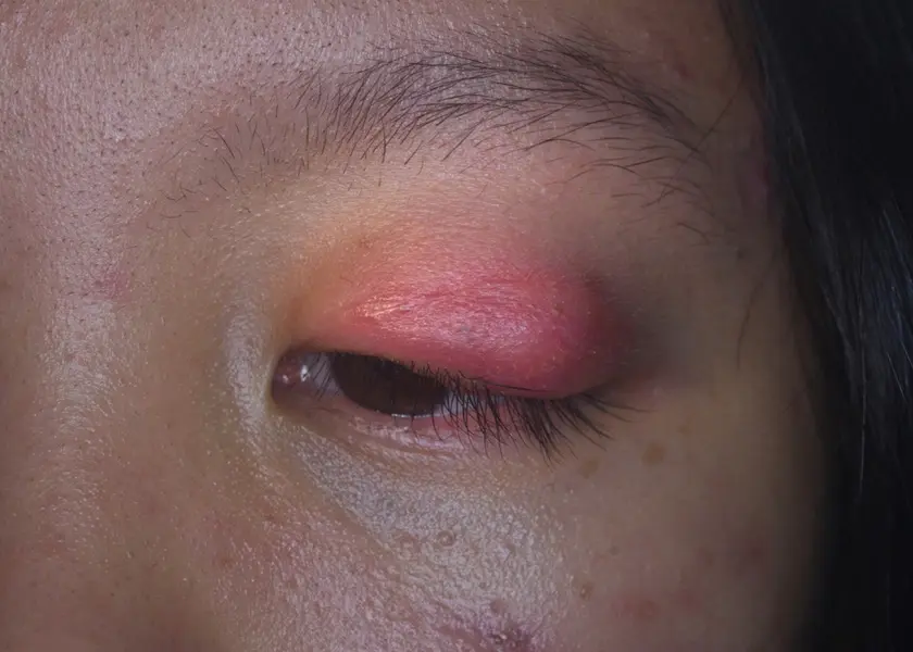 Orbital cellulitis