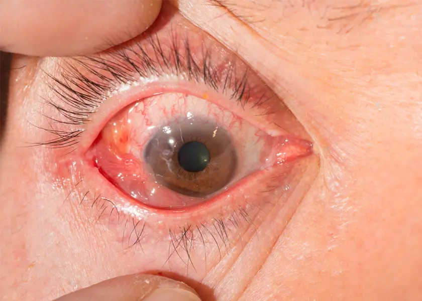 Scleritis